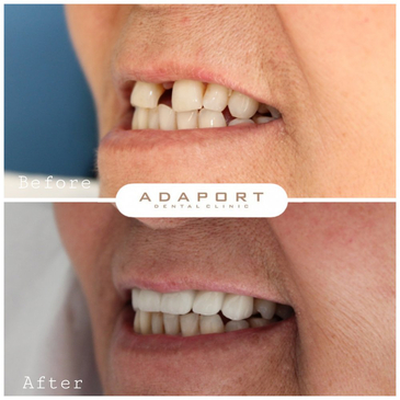 Slider image (3) Adaport Dental Clinic